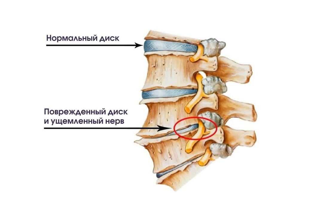 საშვილოსნოს ყელის ოსტეოქონდროზის სიმპტომები